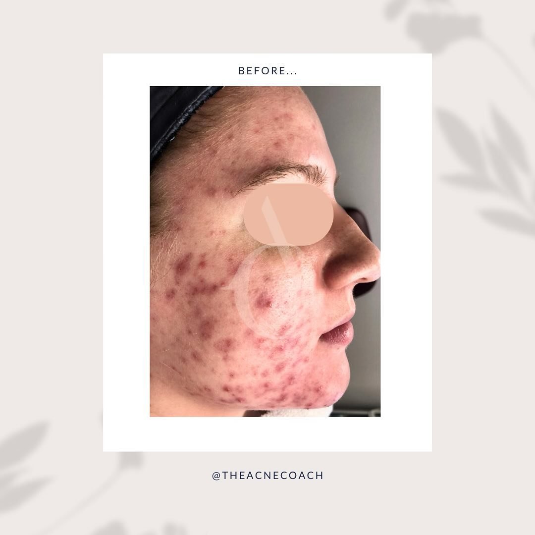 We work with all degrees and types of acne. 

But my favorite clients are the ones who&rsquo;ve tried everything and have given up hope. 

Why? Because I have the opportunity to show them that they really CAN have clear skin, and that there IS hope.
