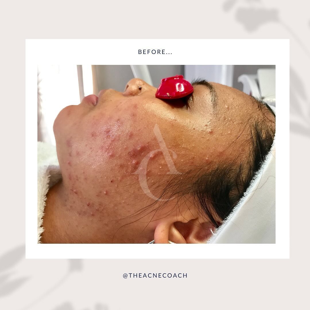 Most of the time, acne takes 12 weeks to clear. But I have some lucky clients whose skin clears up in 6 - 10 weeks, even after having acne for years! This client&rsquo;s acne was caused by clogging makeup and skincare products. As soon as she changed