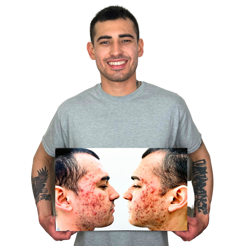 Picture of How to Address Hormonal Acne With Changes to Your Diet