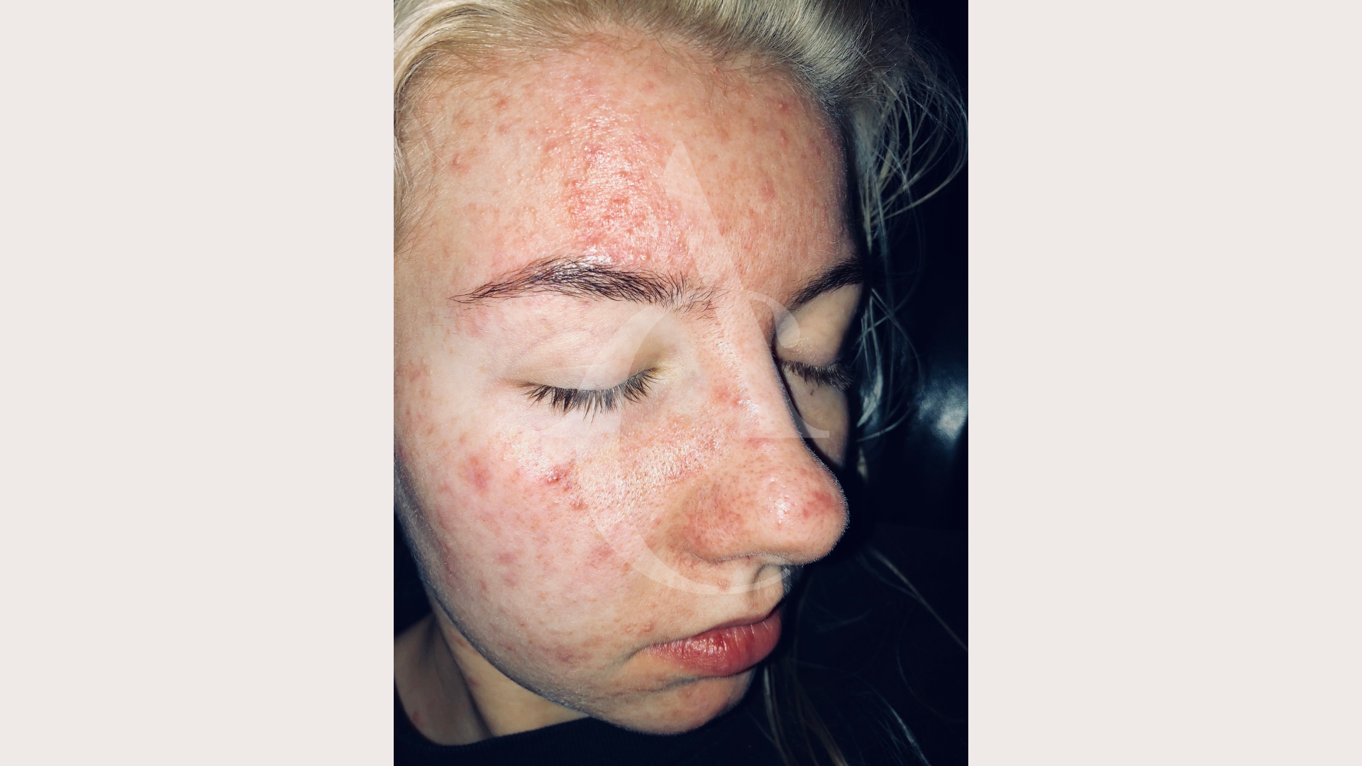 Image showcasing Acne Caused by Skin Care Products — Elements Skin Care & Acne Clinic
