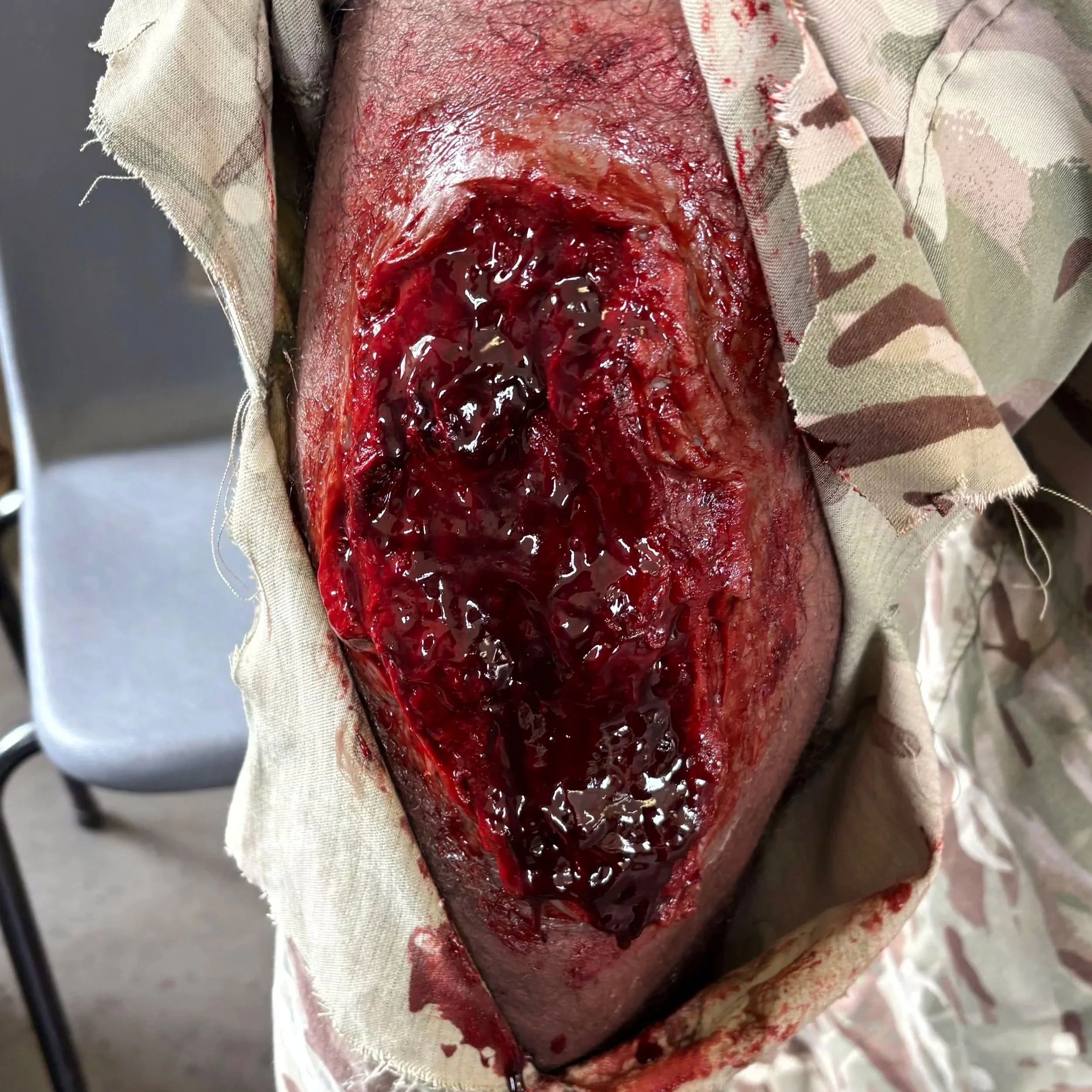 A close-up of an open wound on a person's leg, surrounded by blood and tissue, with medical gauze fabric nearby.