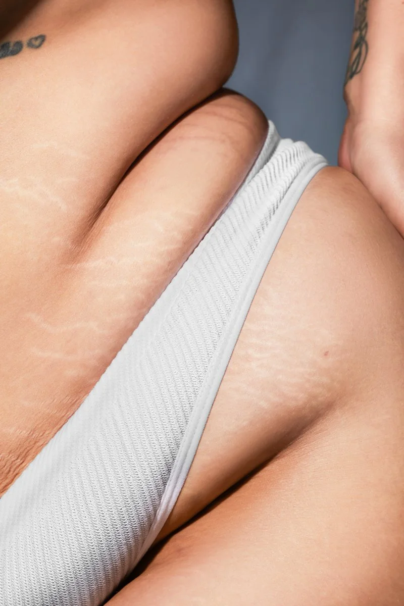 Close-up of a person's waist and thigh, wearing white underwear, with visible stretch marks.
