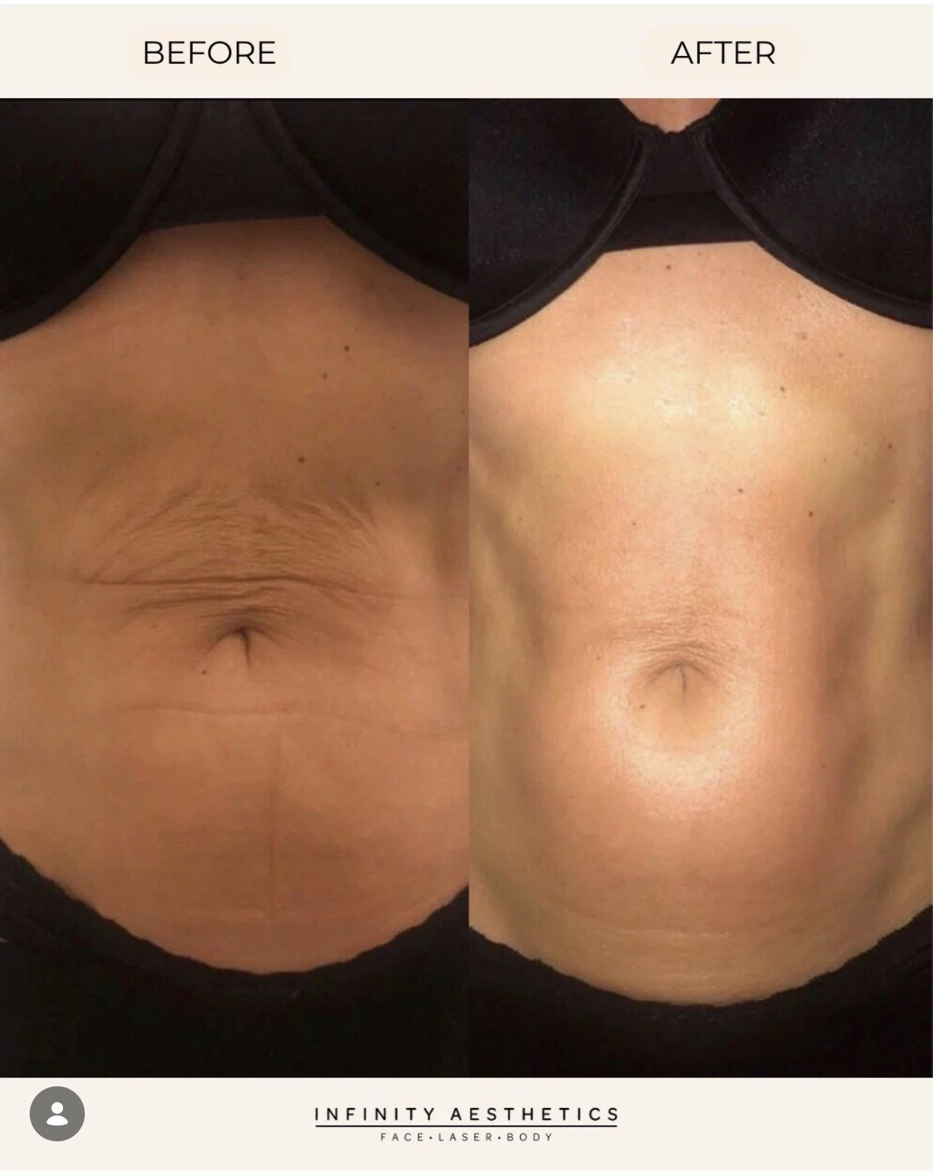 Be summer ready with LipoShape Pro, at Infinity Aesthetics.