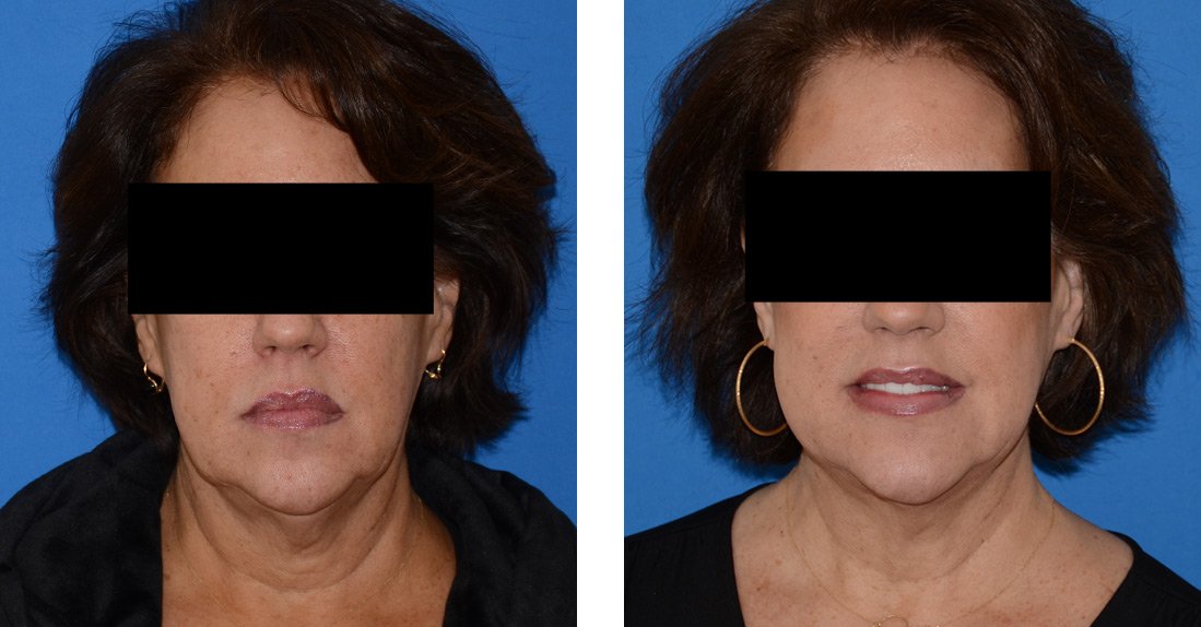 Profound and submental lipo 3mo