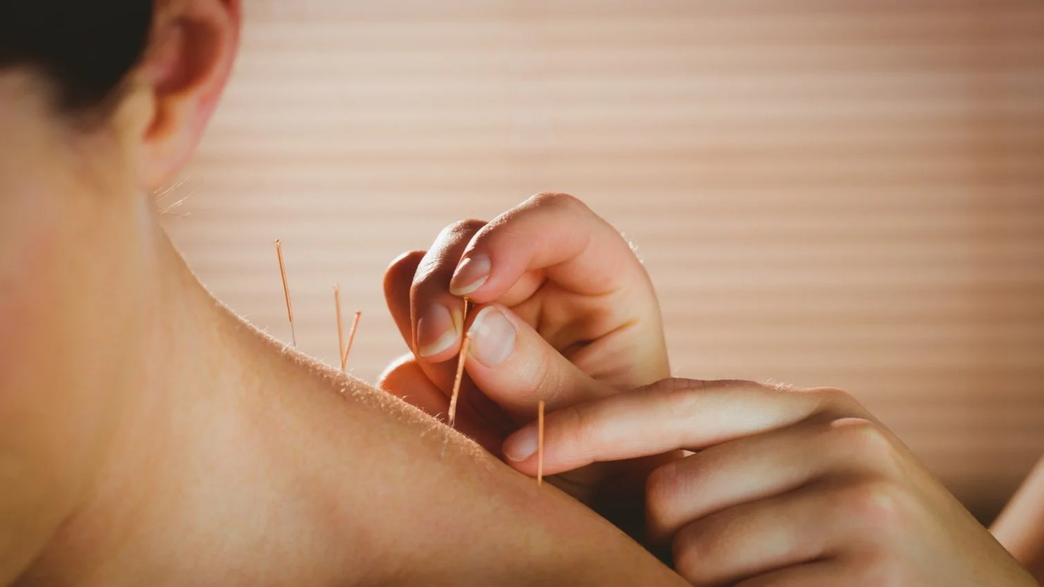 Acupuncture.jpg