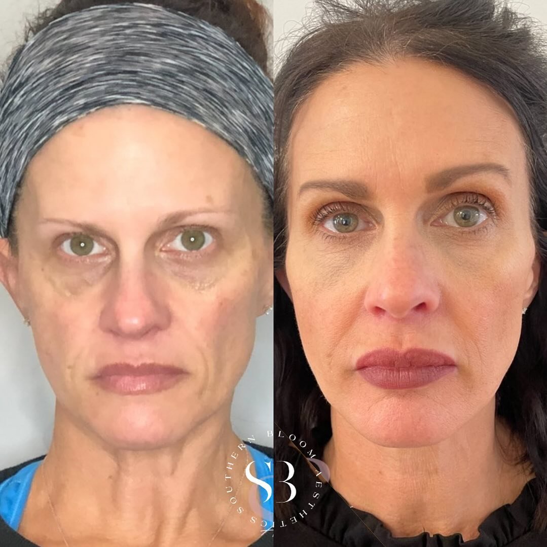 WOW! Check out one of our favorite transformations! 😍

These pictures are 2 years difference. This patient has received Dysport, Filler, Sculptra, PRP, Chemical Peels and Skin Care.

Consistency and and the right guidance is key! Use the link in our