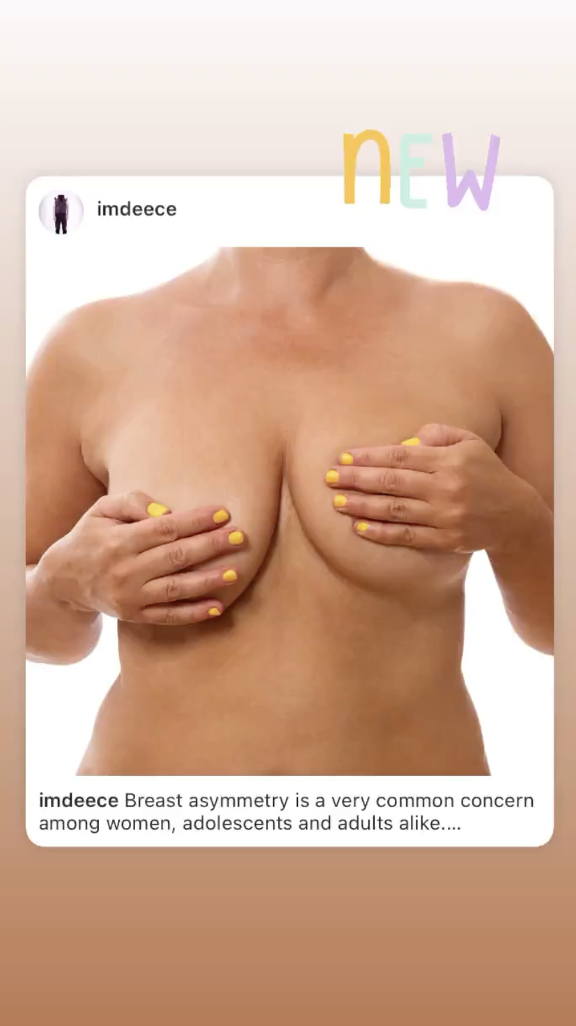 No Shame breast asymmetry artwork – body image parody of No Name (Copy) (Copy)