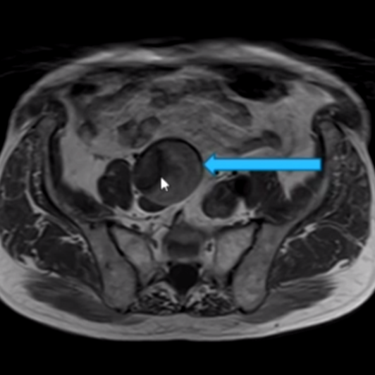 PROSTATE Imaging