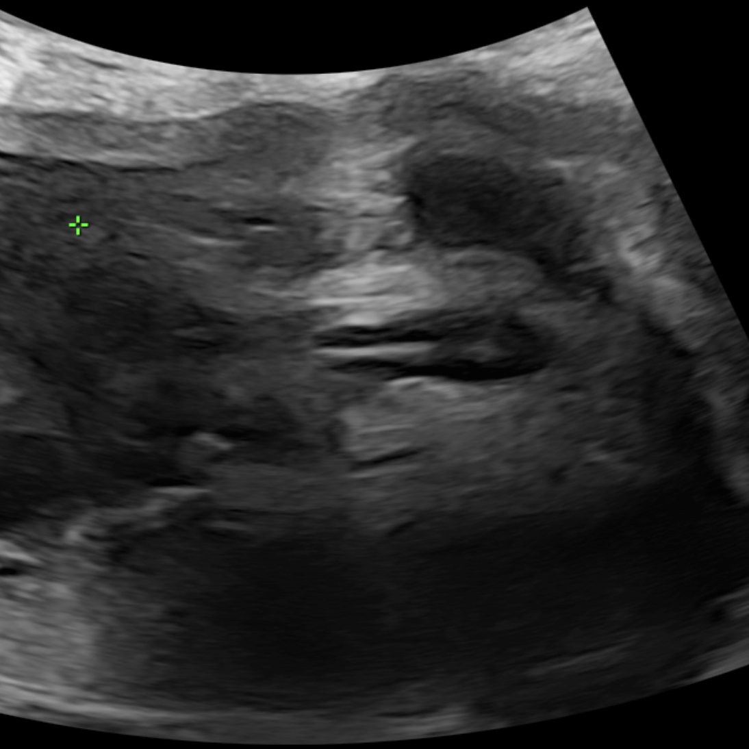 BẤT THƯỜNG HẬU MÔN – TRỰC TRÀNG (ARM): NHỮNG THÁCH THỨC TRONG CHẨN ĐOÁN TRƯỚC SINH