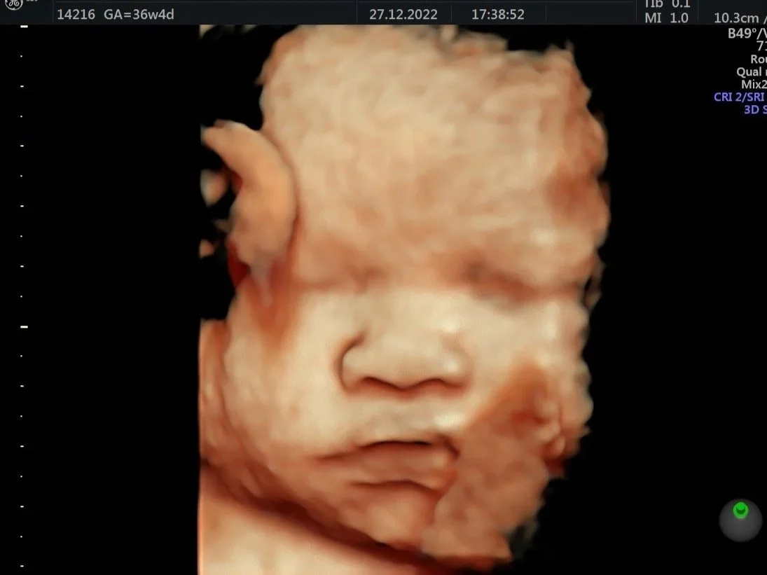 3D ultrasound image of a baby's face, showing facial features like nose, lips, and closed eyes.