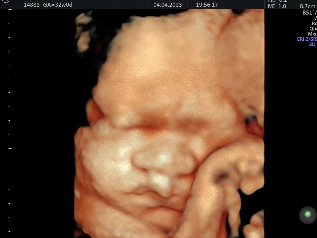 3D ultrasound image of a fetus in the womb, showing facial features and hand near the face.