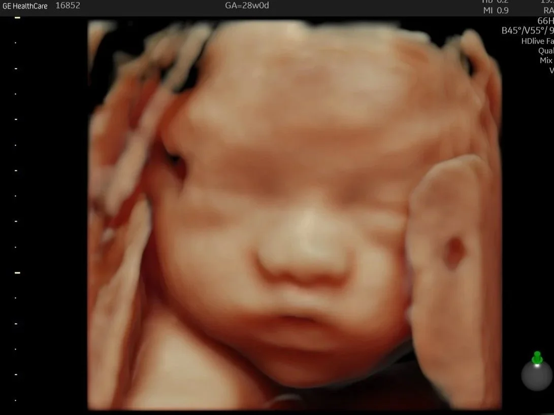 3D ultrasound of a fetus showing a detailed view of the face, including closed eyes, nose, and mouth.