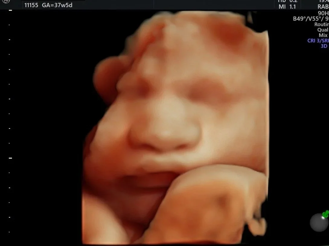 A 3D ultrasound image of a baby in the womb, showing facial features and hand near the face.
