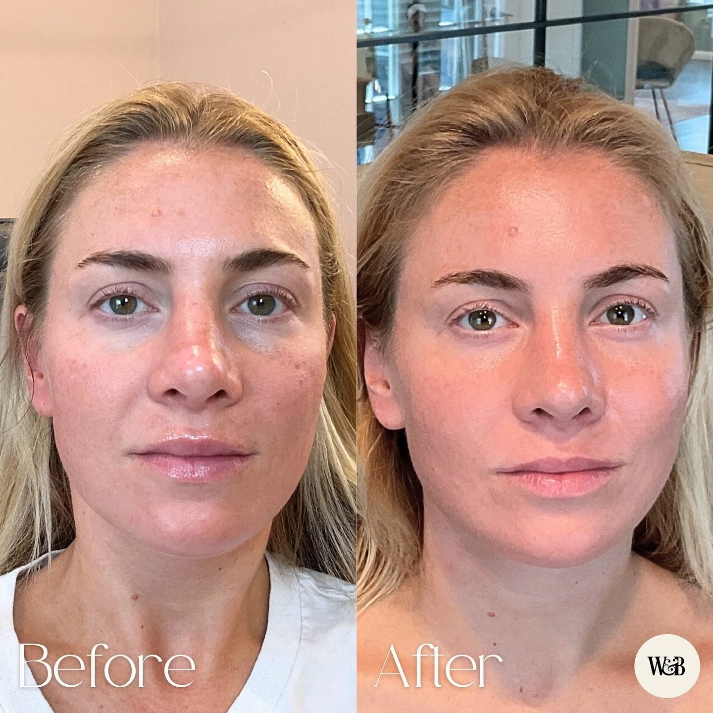 Some people buy eye cream. Others get PRF 👀
PRF does what eye cream can’t. It helps rebuild collagen and support from within, so the skin under your eyes looks smoother, brighter, and a lot less “I haven’t slept since 2019.”
