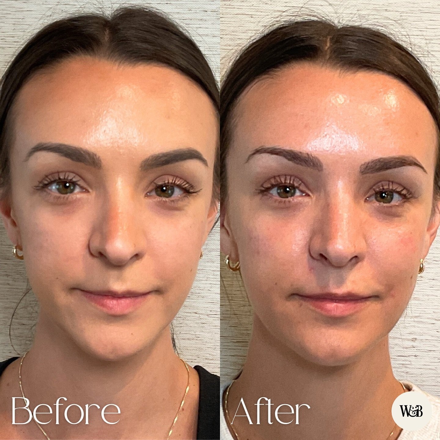 Cheek filler doesn&rsquo;t have to be obvious to make a difference. 😍

When done subtly, it can do wonders for structure, balance, and create that refreshed, well-rested look everyone&rsquo;s after.✨

#cheekfiller #medspa #austinmedspa #austinbeauty