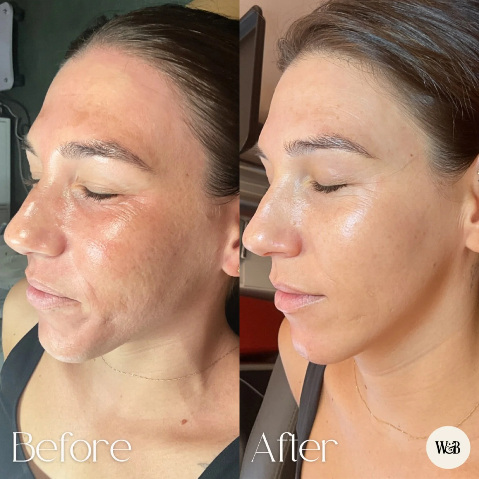 That post-laser glow is no joke 🔥

Erbium YAG smooths rough texture, brightens dull spots, and pretty much tells tired skin to pull it together. We call it a baby CO2 with less down time. 💁&zwj;♀️

#medspa #austinmedspa #austinbeauty #nursepractiti