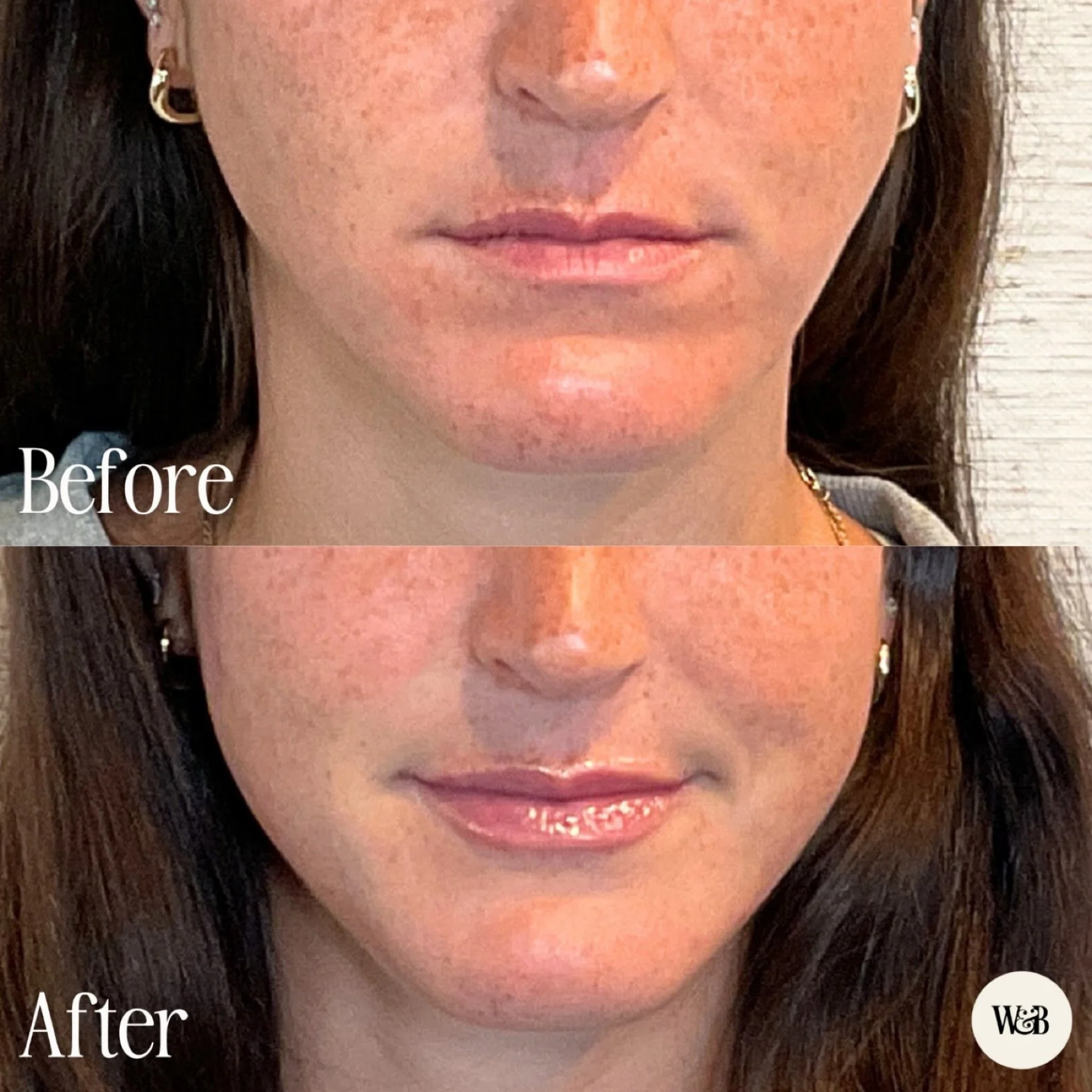 A subtle lip refresh, focused on balance 💋⚖️

This before and after shows what happens when filler is used to support what&rsquo;s already there. A little structure, a touch of hydration, and smoother edges that bring everything into proportion with