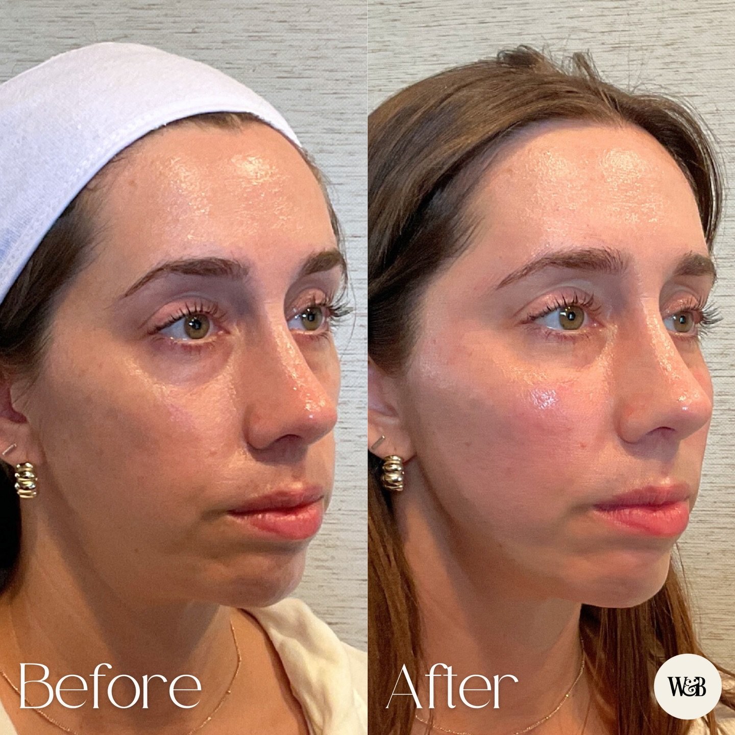 A little facial balance goes a long way 💫

This kind of result comes from stepping back and looking at how everything works together. Tox and filler, placed with intention to soften, support, and bring the face back into alignment. ⚖️

#medspa #aust