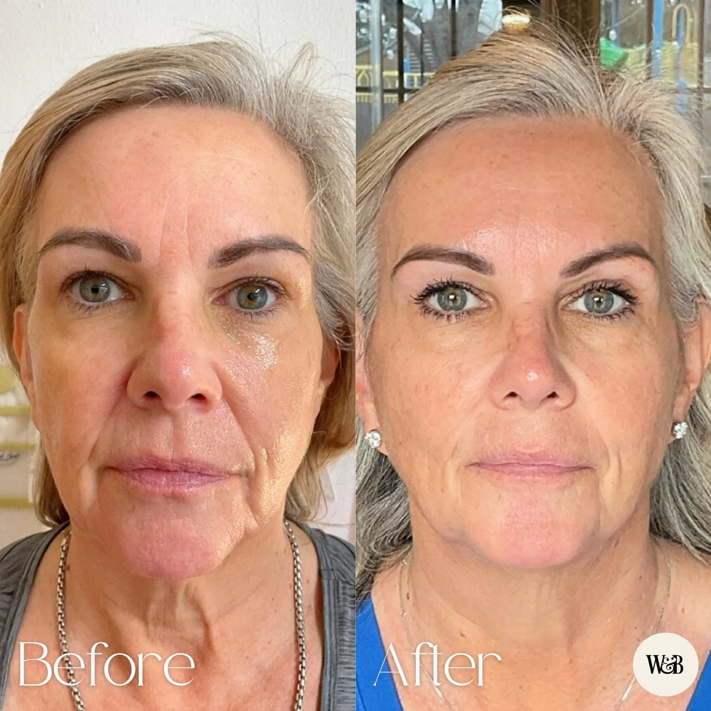 Two years of collagen building with Sculptra, and the difference speaks for itself ✨

This is a collagen biostimulator that helps improve skin laxity and facial volume loss gradually, creating more midface support and smoother transitions without loo