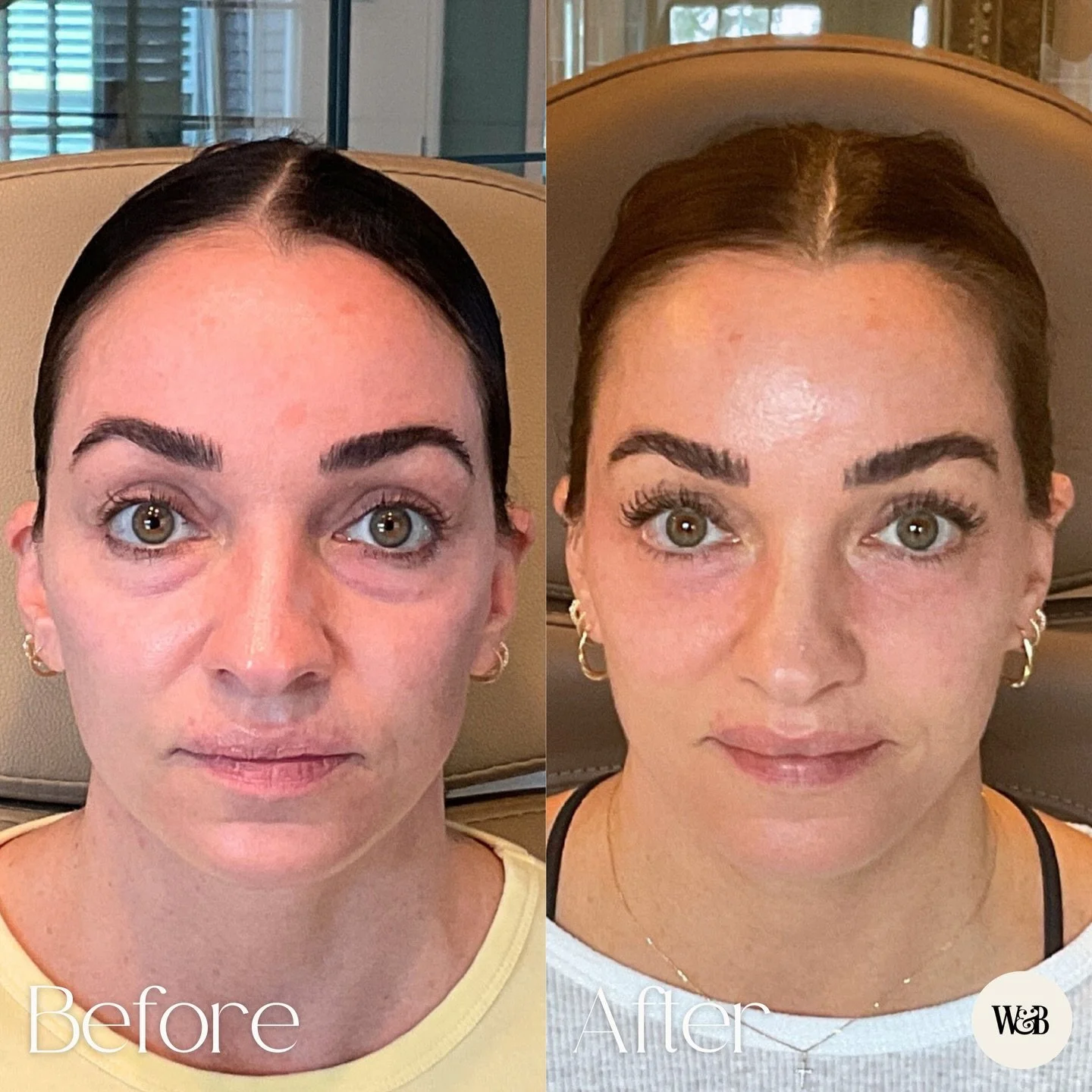 PRF under eyes is our not-so-secret weapon for under-eye hollowness, dark circles, and crepey texture. 🧬✨ It&rsquo;s your body&rsquo;s own growth factors, so results build gradually and stay super natural. If you&rsquo;re looking for under-eye rejuv