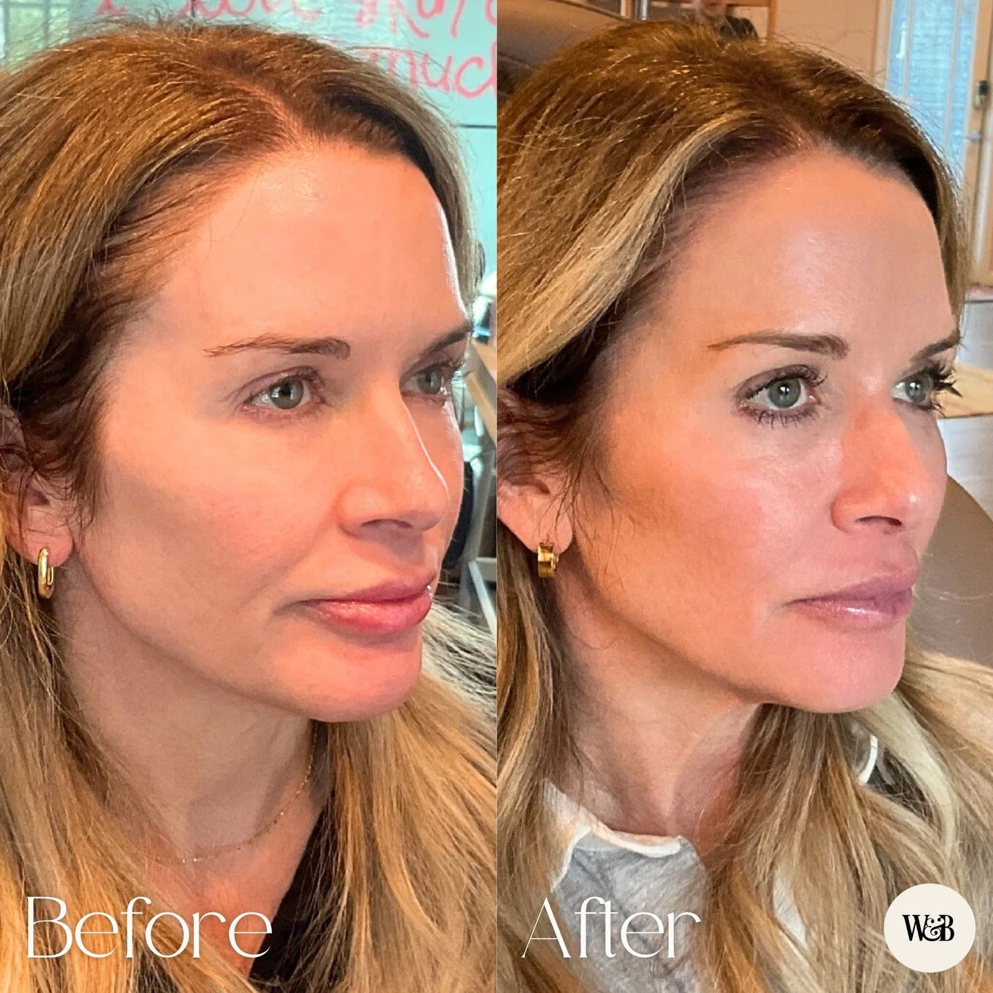 Sculptra results like this are exactly why we&rsquo;re obsessed lately 💫 It&rsquo;s a collagen stimulator that improves skin firmness and facial volume over time, especially midface support and softening lines. Want natural-looking facial rejuvenati
