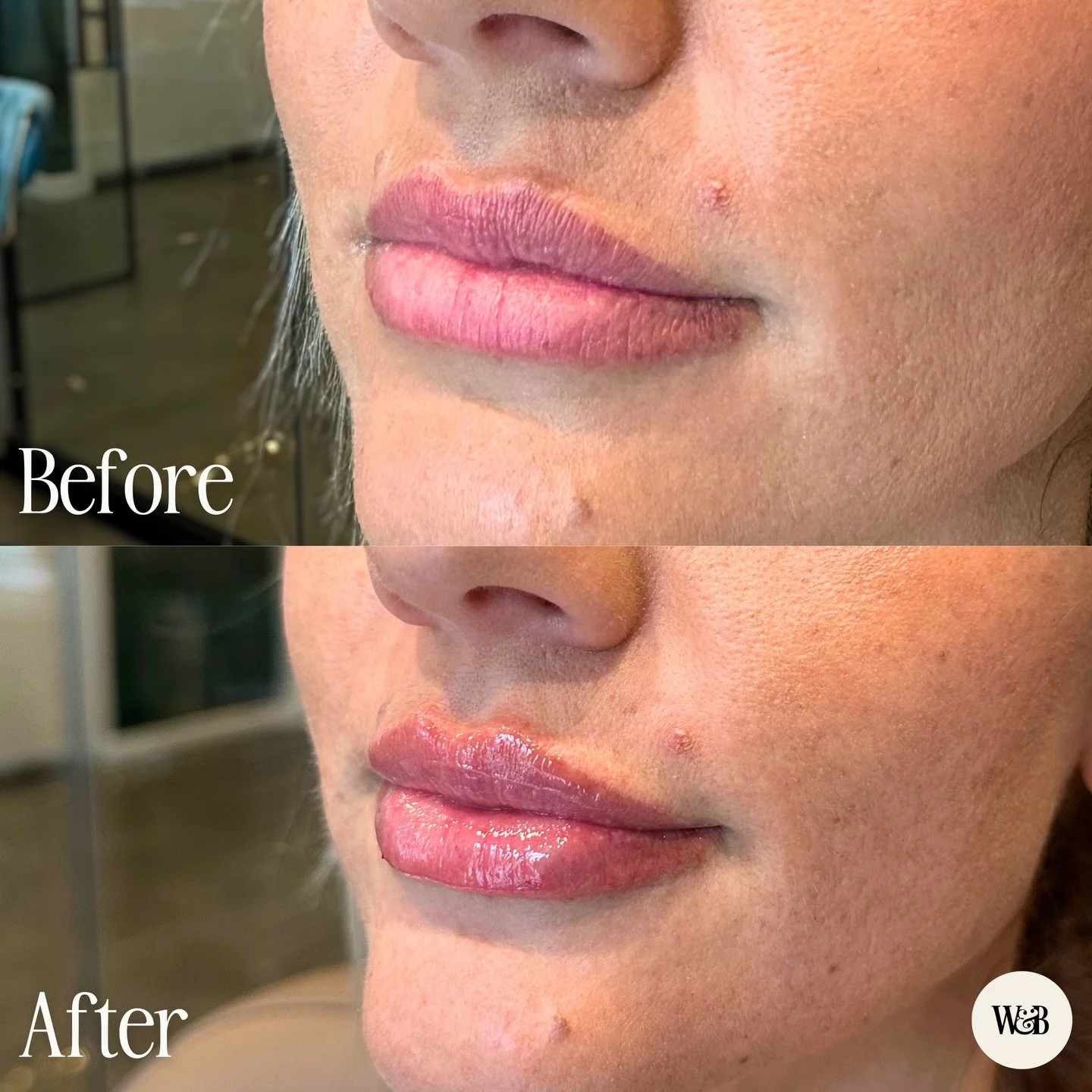 A little lip refresh for this sweet client 💋

She didn&rsquo;t need a dramatic change, just a little more shape and support so everything looked more even. Just enough filler to smooth things out and make the overall lip shape feel more balanced.

#