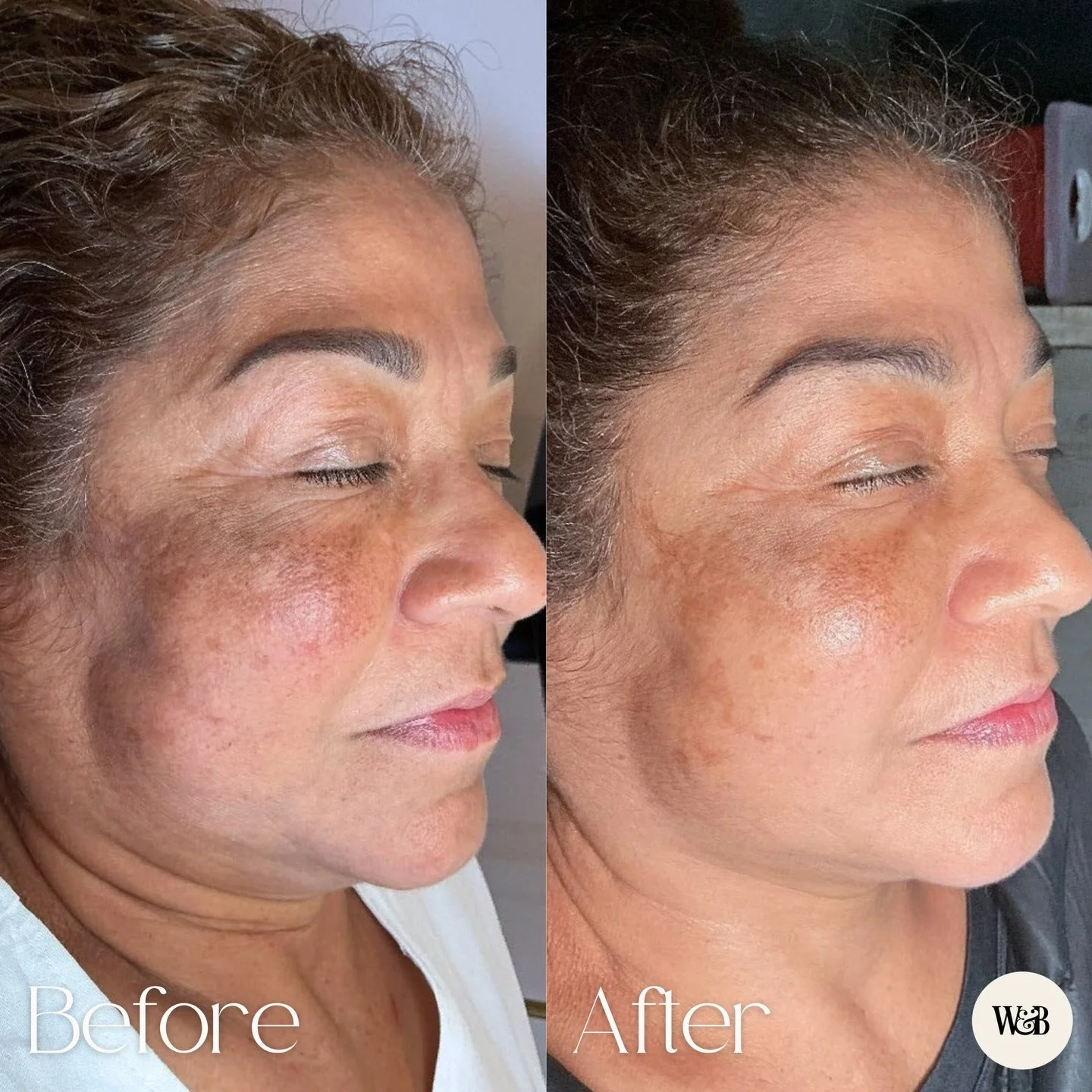 3 VI Peel sessions later, and this is why consistency matters ✨

Treating pigmentation takes patience. Sun damage, dark spots, and uneven tone usually respond best to a series, not a one off treatment.

This VI Peel before and after is exactly why we