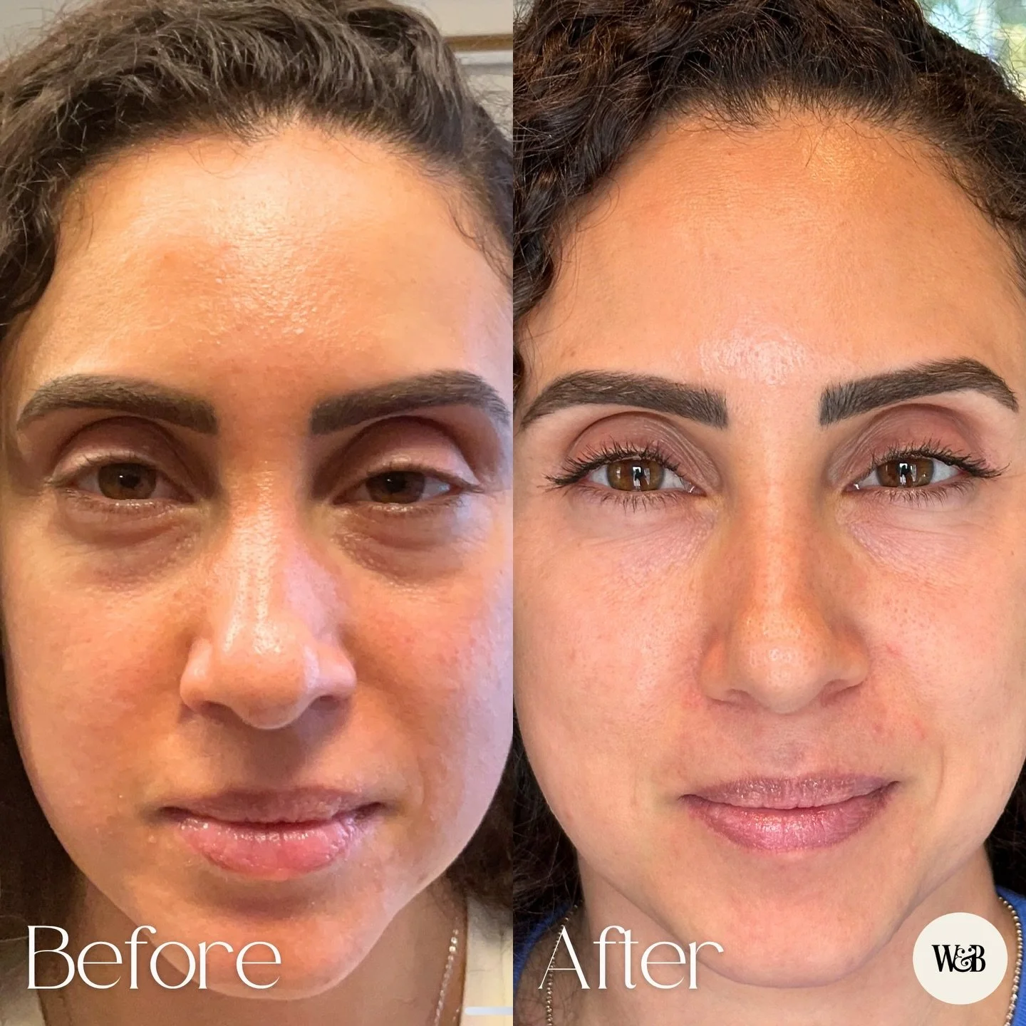 THIS is what consistency does 🤩

Over the last two years, we treated this under eye area with PRF under eyes and PRF EZ Gel, and the difference is such a good reminder that regenerative treatments really build over time.

Brighter, smoother, more su
