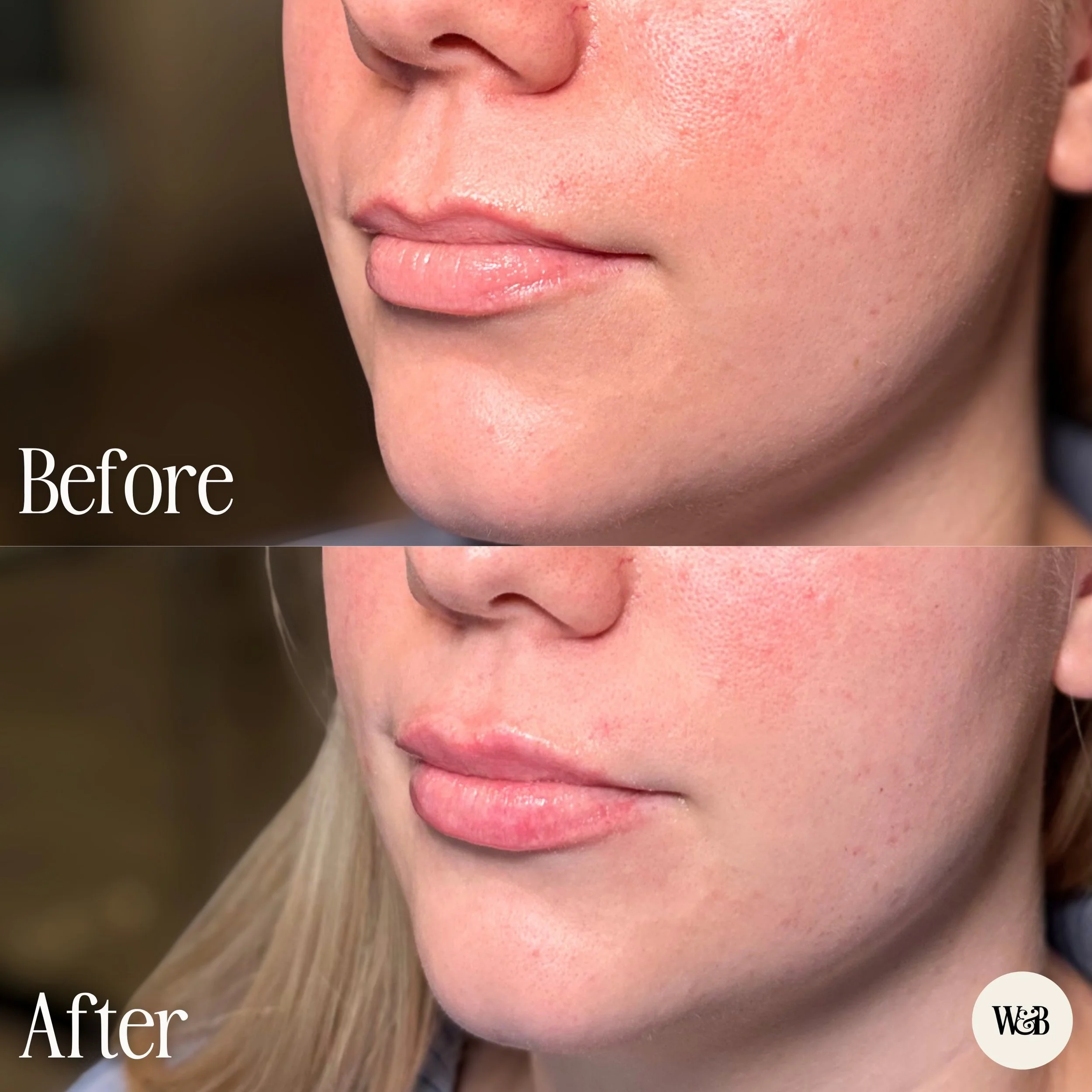 A little lip filler can do a lot when the goal is balance, not just volume 💋

Here we focused on subtle lip filler to even things out, support the shape, and bring a little more harmony to the lips without making them feel overdone. Just enough to m