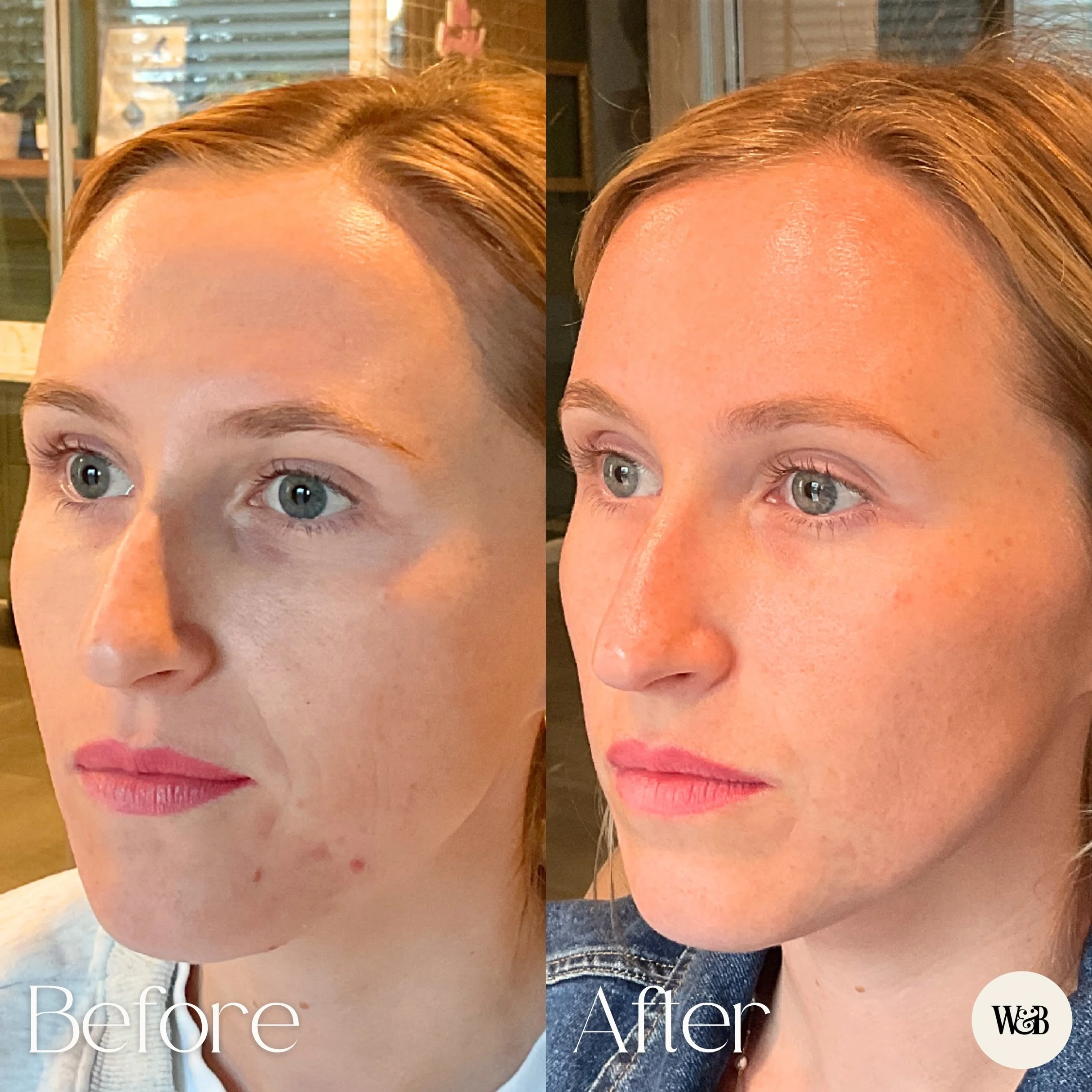 The smile lines weren&rsquo;t actually the problem. The collagen loss was. 👀

By stimulating collagen over time, we&rsquo;re able to create support beneath the skin that can soften smile lines, improve facial balance, and age with you a little more 
