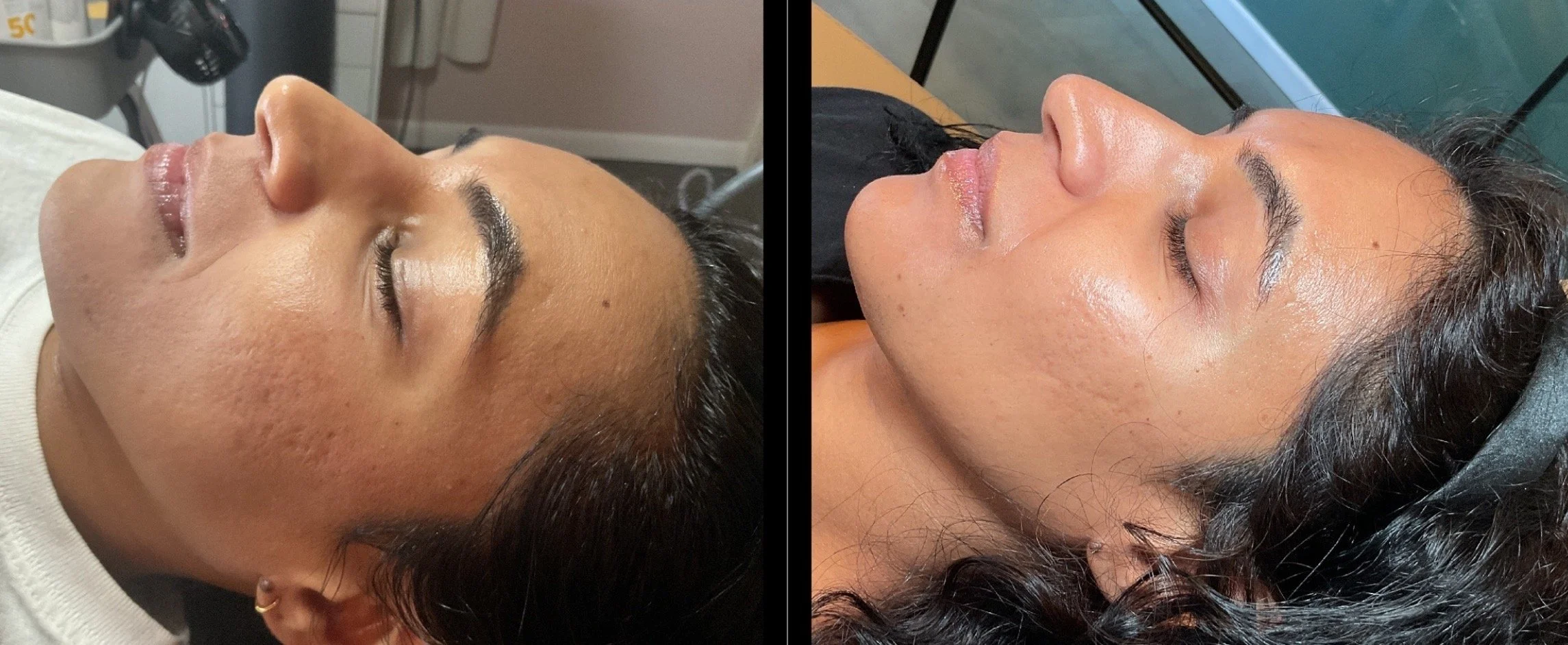 Before & After Erbium YAG treatment at Wild & Beautiful in Austin, TX. Photos taken 1 month apart.
