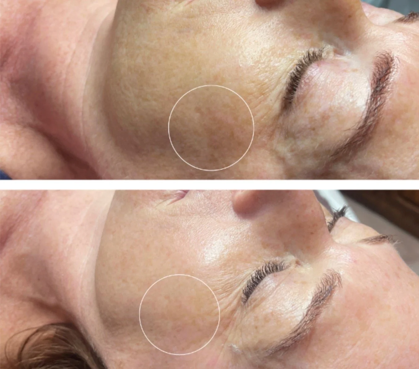 Before & After Rohrer Spectrum Erbium YAG Laser
