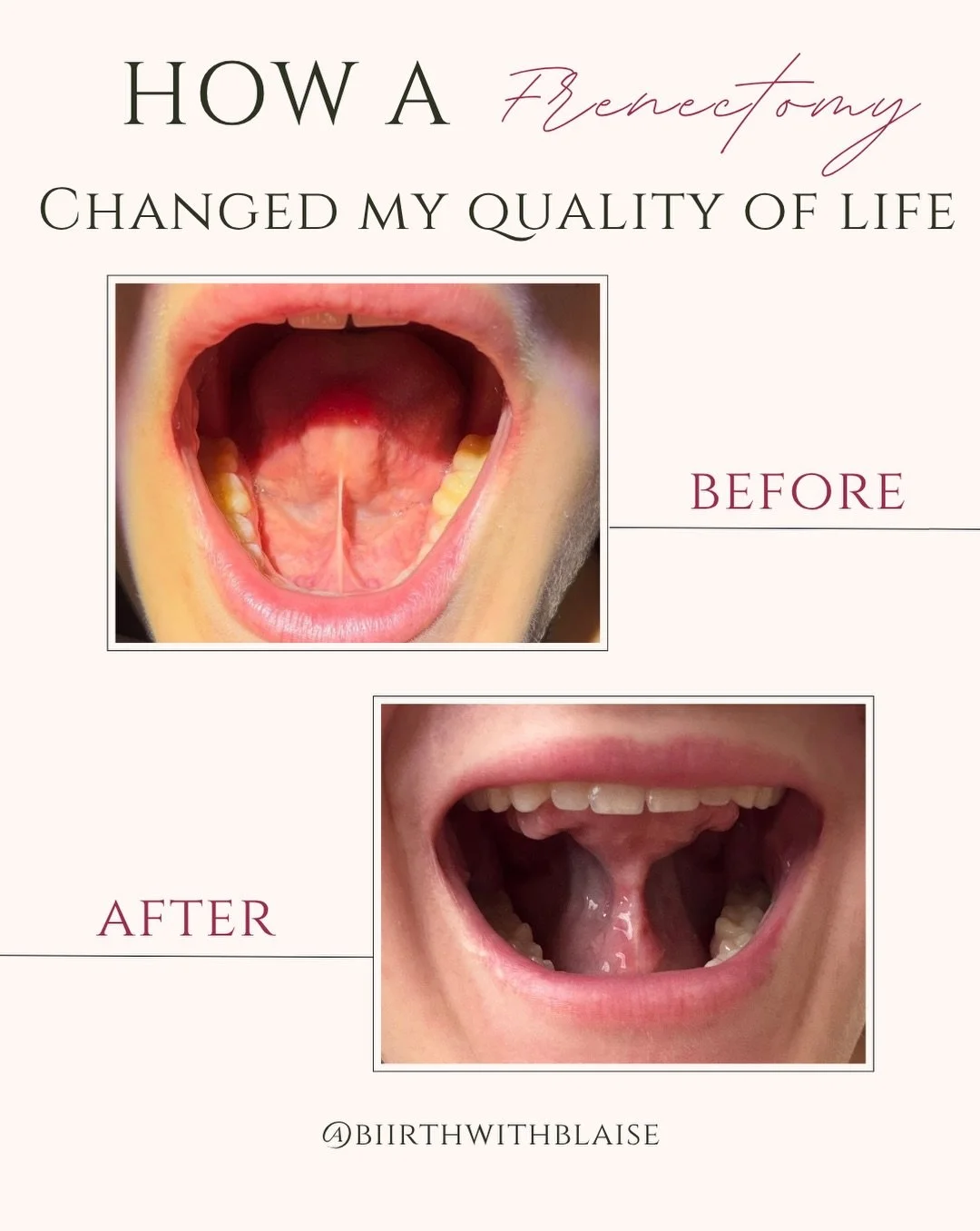 My full adult tongue tie release, Frenectomy story!

👄 ✂️👅

Getting a frenectomy was one of the best decisions I ever made.  I feel sharing my story can give insight to the side of tongue tie releases that is positive, especially for adults and par