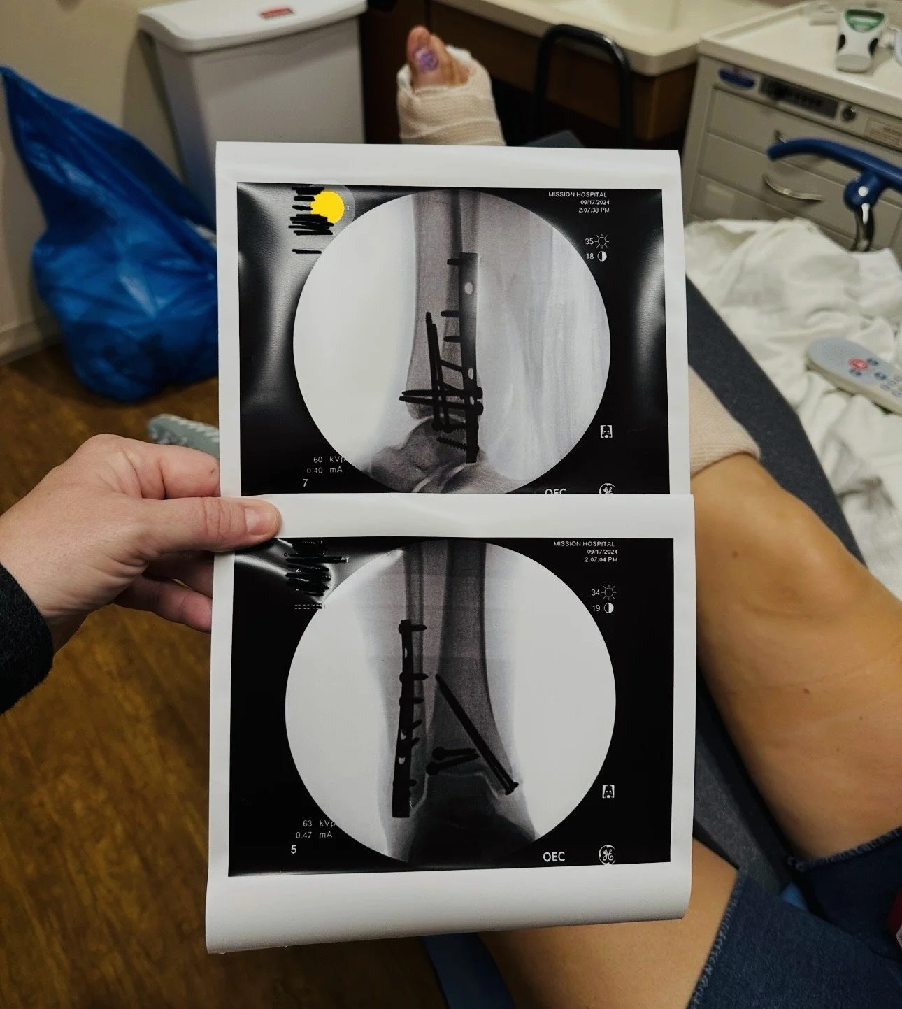 A Personal Testimony: Breaking My Ankle Wasn’t the Worst Part…Healing Was!