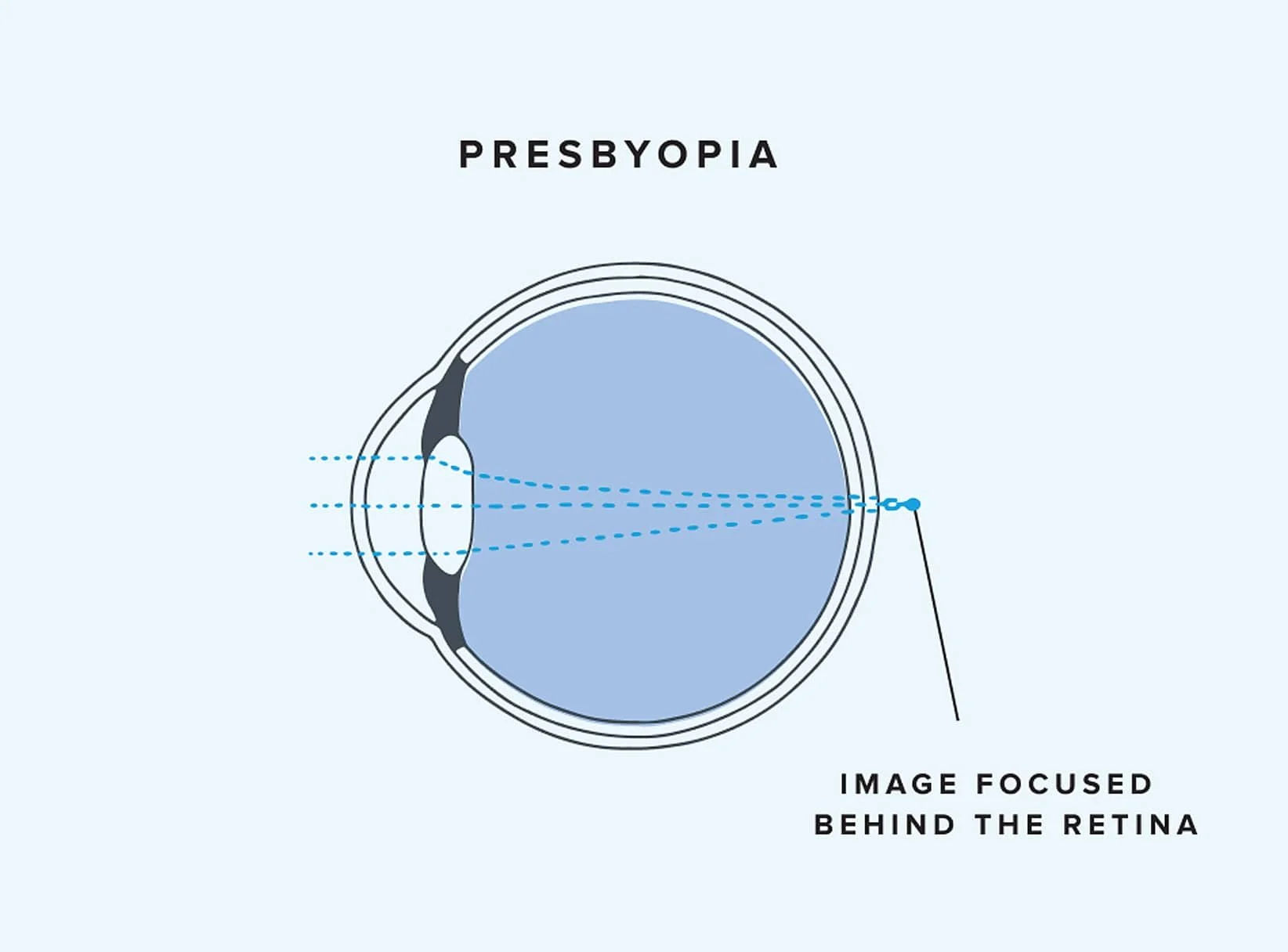 presbyopia-treatment-in-adelaide-cbd