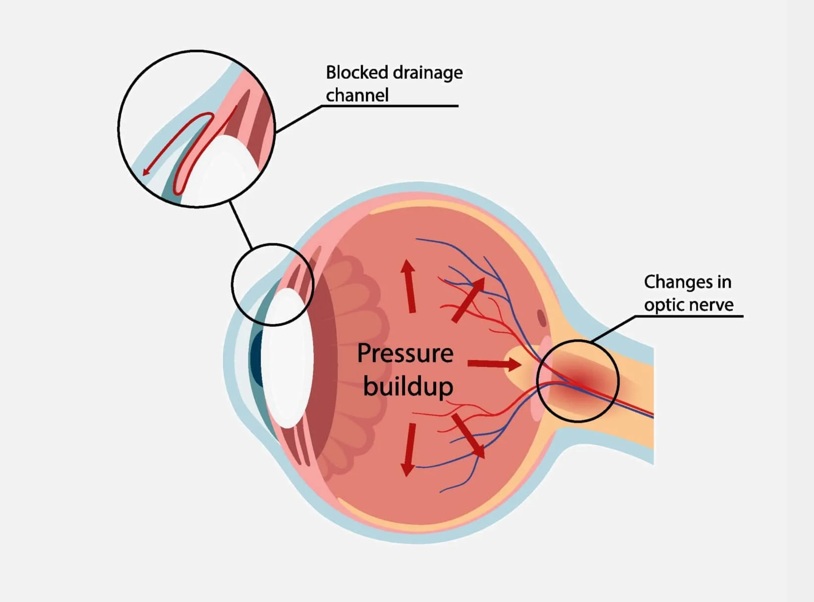 glaucoma-treatment-in-adelaide-cbd