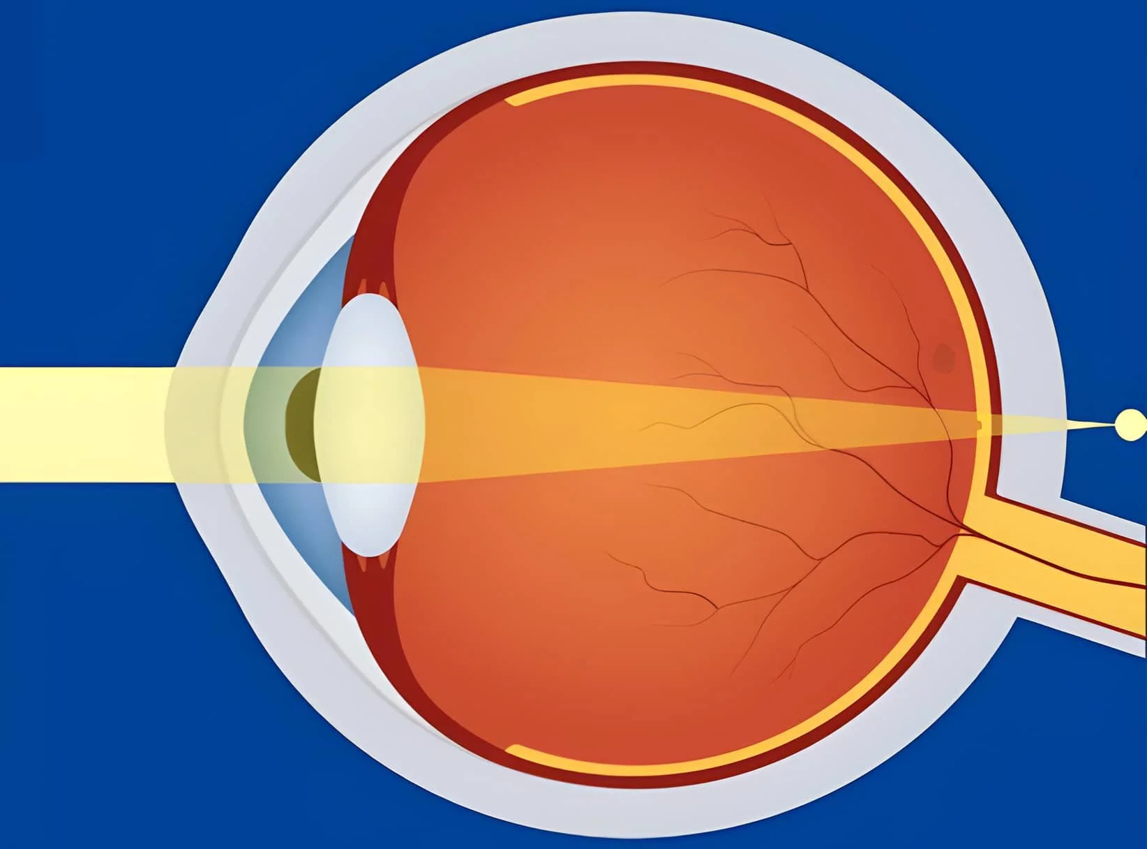 hyperopia-treatment-in-adelaide-cbd