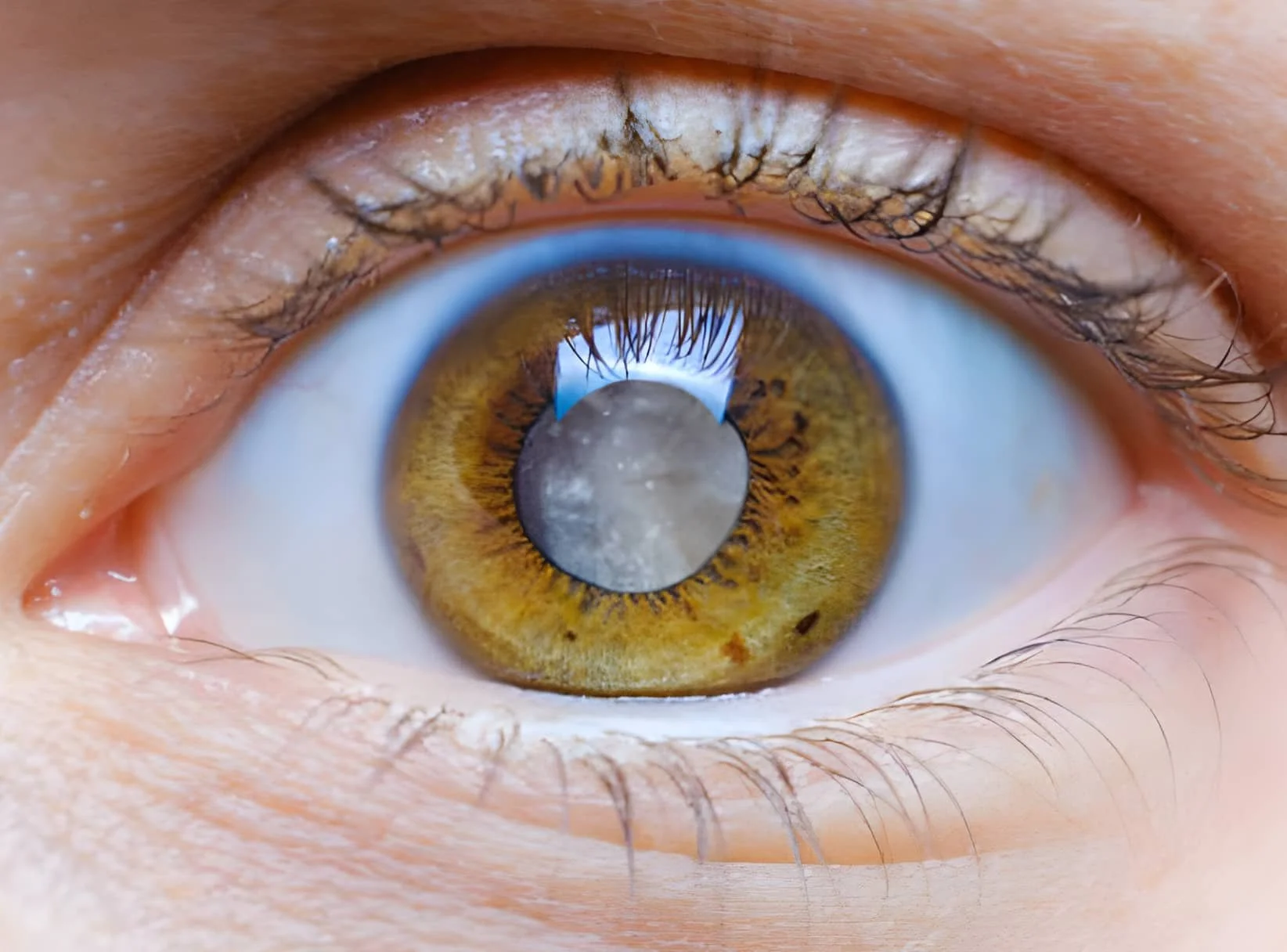 cataracts-treatment-in-adelaide-cbd