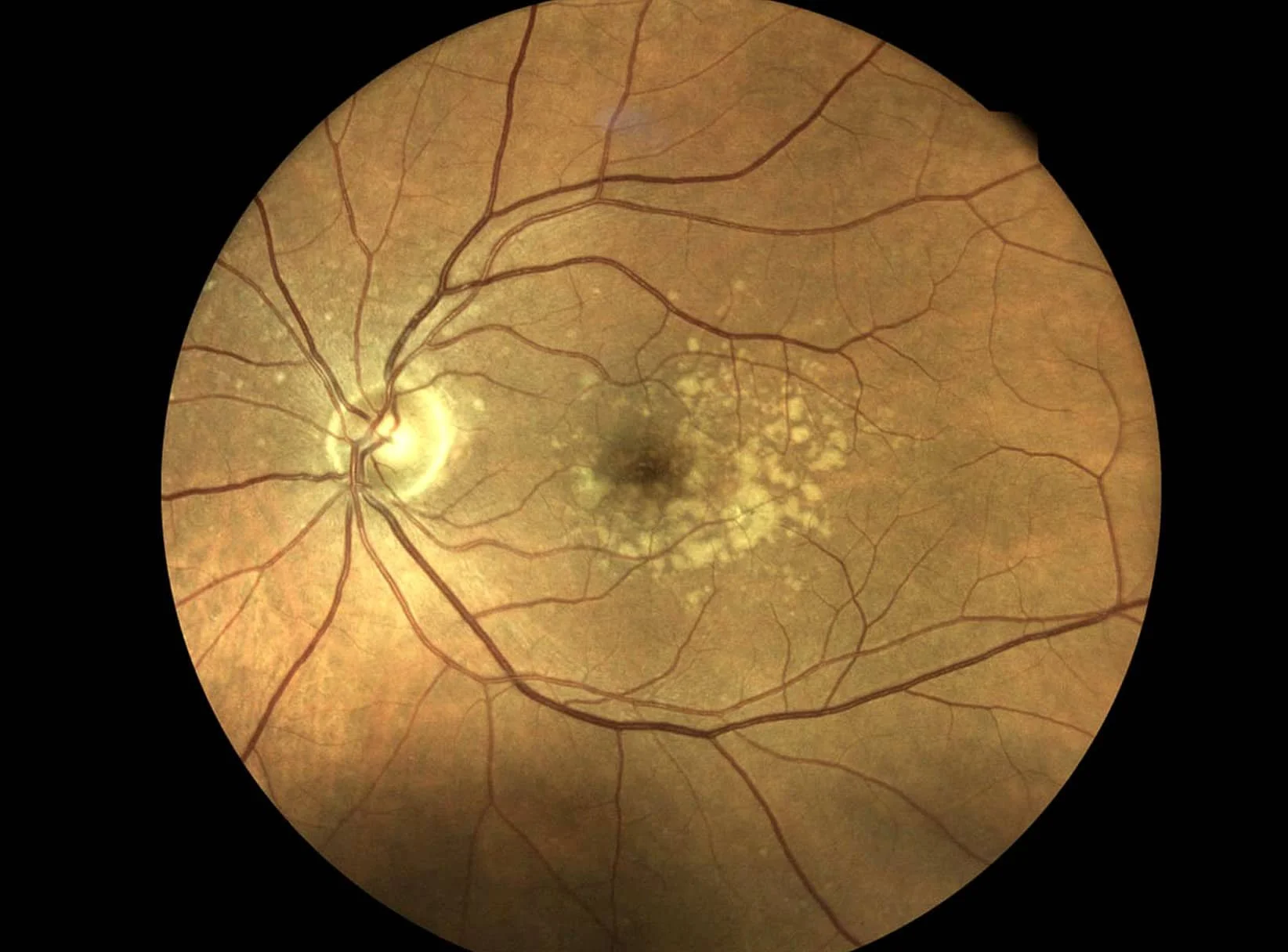 macular-degeneration-treatment-in-adelaide-cbd