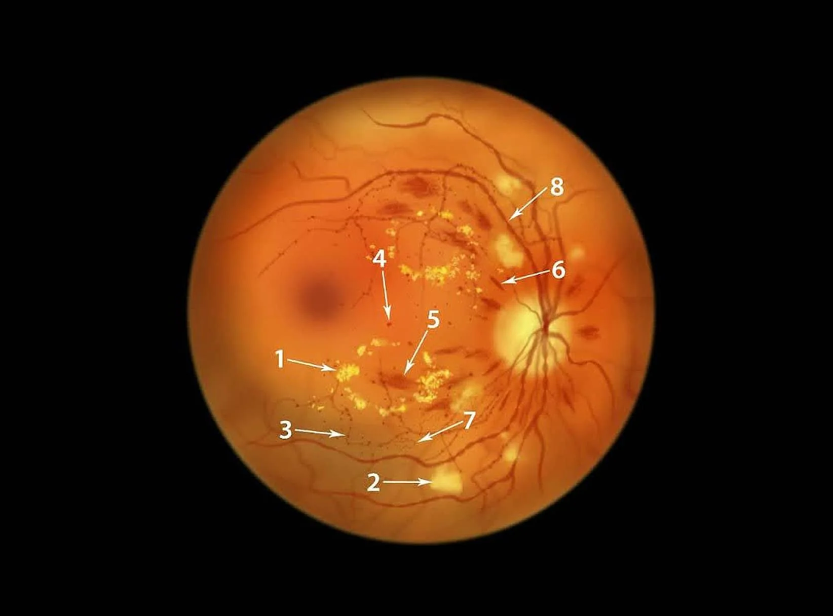 diabetic-retinopathy-treatment-in-adelaide-cbd