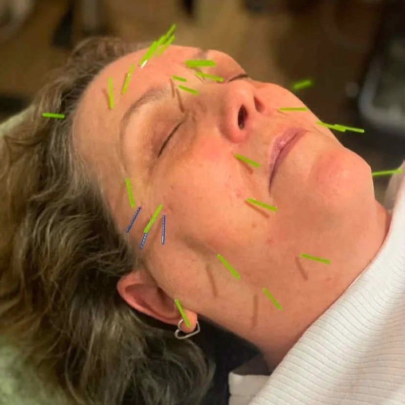 A registered Acupuncture and Chinese Medicine practitioner performing a cosmetic acupuncture treatment by carefully placing fine needles on a patient's forehead to support skin health