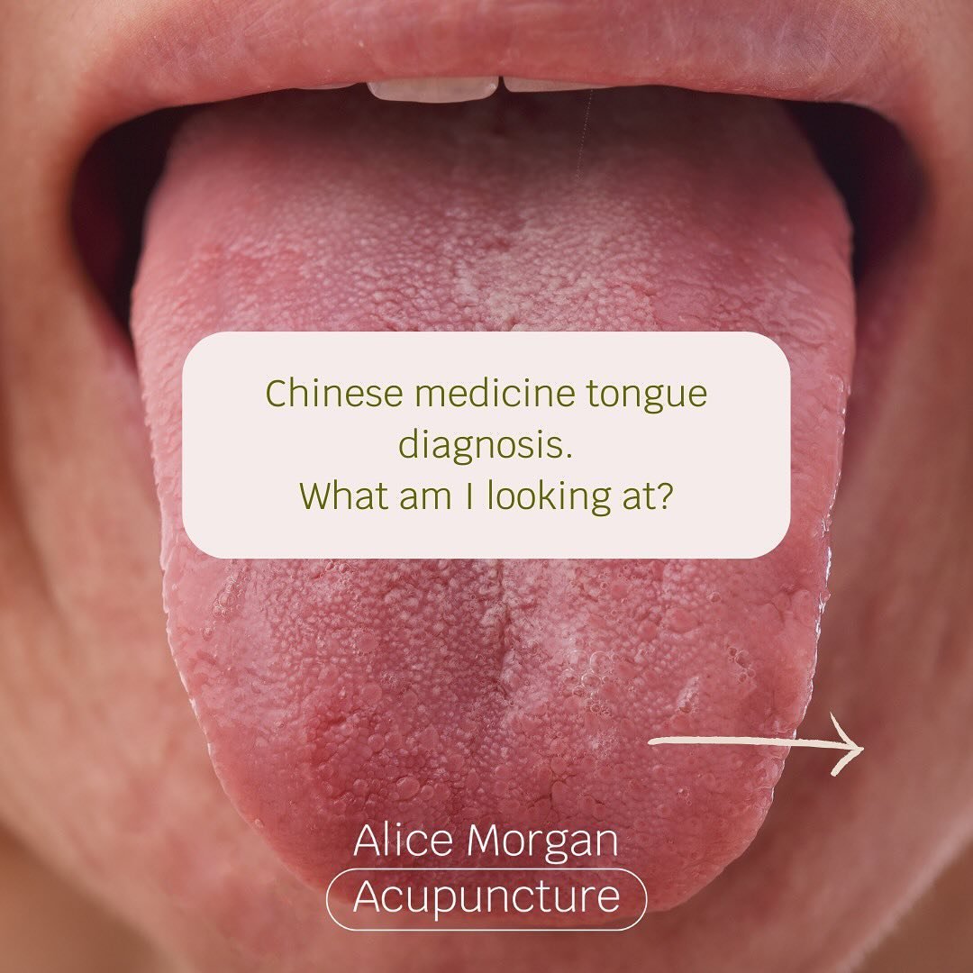 👅 Chinese tongue diagnosis! So much is seen on your tongue! 😜 

What&rsquo;s your tongue saying about your health? 

#chinesedietarytherapy #chinesemedicine #tongue #tonguediagnosis #tcm #acupuncture #chinesemedicineworks #tranditionalchinesemedici