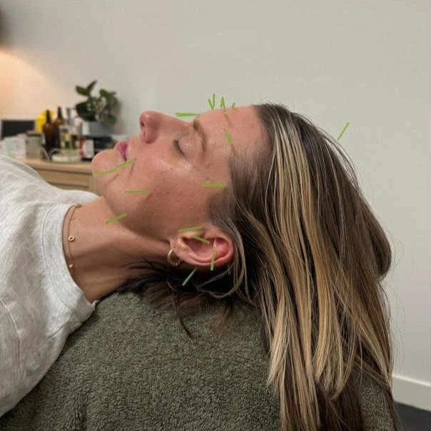 Traditional Chinese Medicine practitioner applying facial acupuncture to support jawline skin health and stress reduction