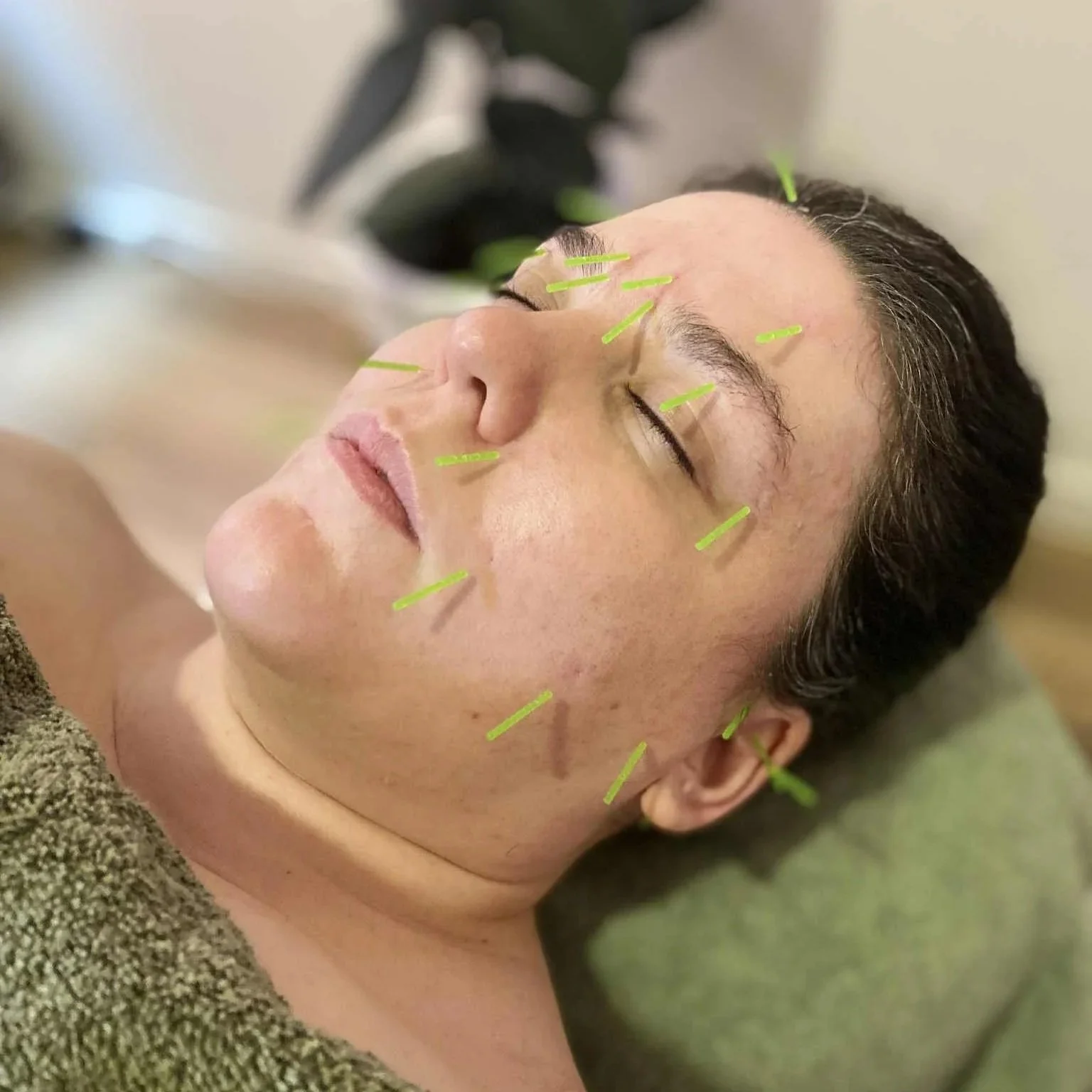 Close-up of a facial acupuncture treatment focusing on traditional pressure points to support skin vitality and wellness.