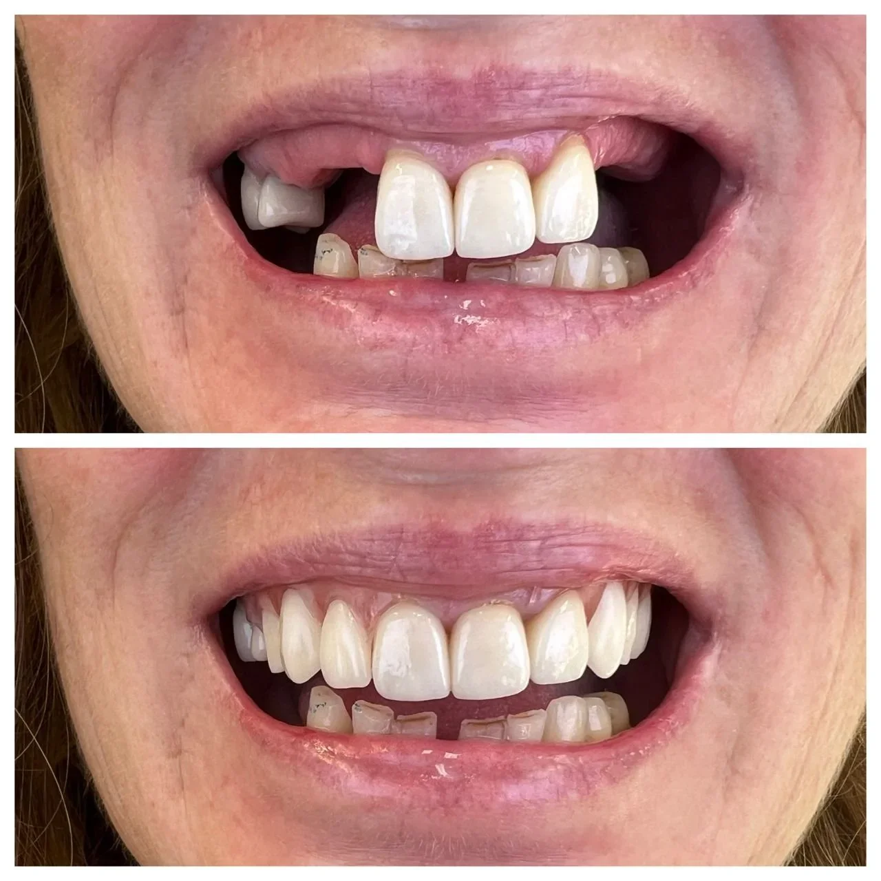 Can dentures be repaired the same day?