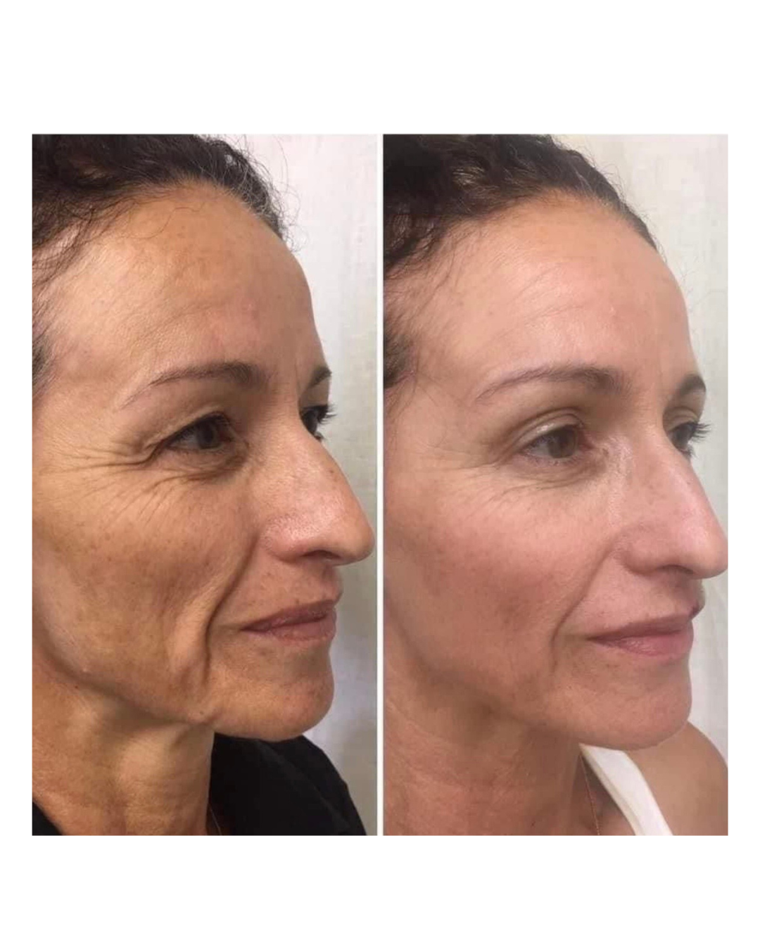 Ozempic Face &amp; Facial Volume Loss | Med Spa in Hobbs, NM