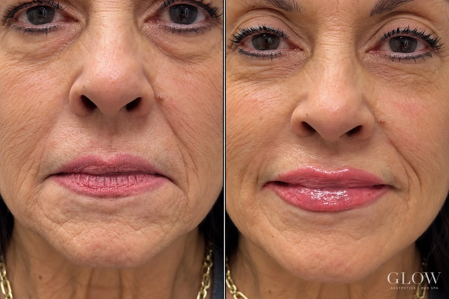 Sometimes a subtle touch of Filler 
is all you need. POOF!! 

Glow Aesthetics | Med Spa
📍 Hobbs, NM
glowaestheticsmedspa.com

Francine Williams, FNP, MSN, MEP-C
Monica Valencia, BSN, RN
Katie Quiroga, RN
Jamie Ross, LPN
Kya Taylor, BS, MA-C