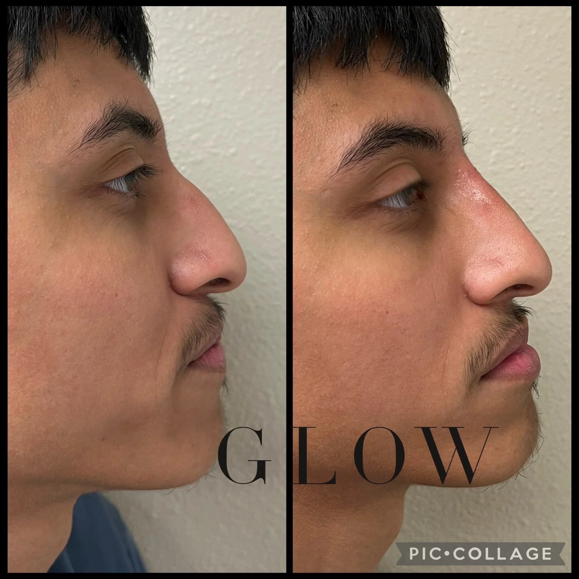 Nose filler offers subtle reshaping without surgery. It can smooth the appearance of bumps, improve symmetry, and enhance the profile with minimal downtime. Hyaluronic acid filler is temporary and can be dissolved if needed. Results may last a year o