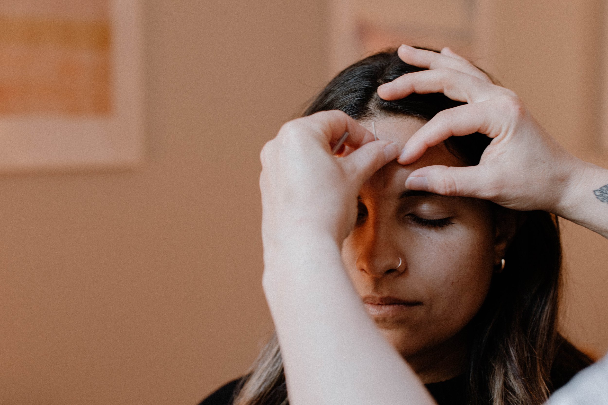 Person receiving Yintang acupuncture point for stress and burnout