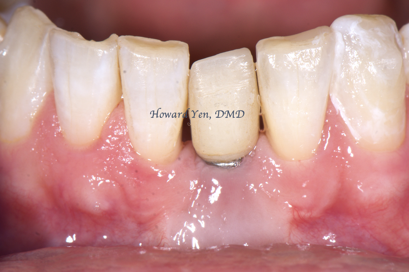 Peri-Implant Disease Case 1 (Post-OP)